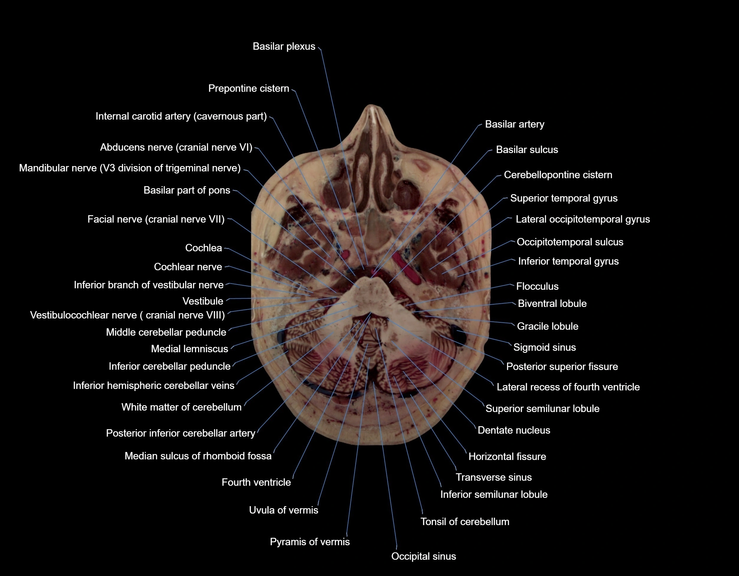 MRI Brain axial cross sectional radiology anatomy 3T image  -img-000017.webp